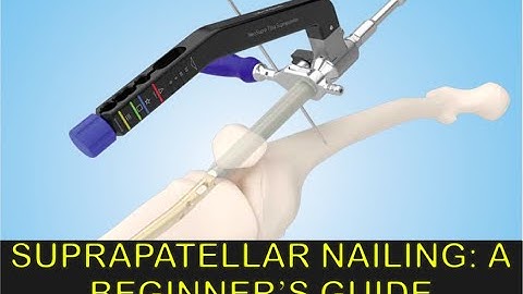 SUPRAPATELLAR NAILING: A BEGINNER’S GUIDE