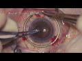 Cornea transplant  pkp  and phacoemulsification  with lens implantation