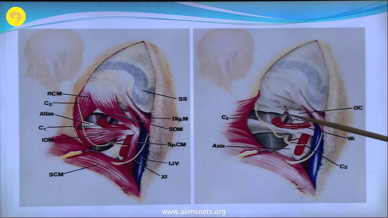 Far-lateral approach to the Foramen magnum - YouTube