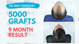 Manual FUE Hair Transplant Before & After, 5000 Grafts 9-Month Result - ASMED - Dr. Koray Erdogan