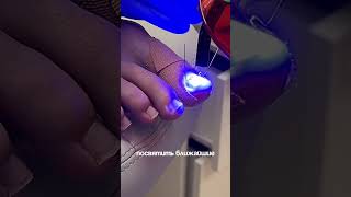 Скоба 3ТО #подолог #скоба3ТО#вросшийноготь #ксенияроманюк