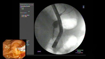 ERCP ; Papillitis from recently passing CBD stone.