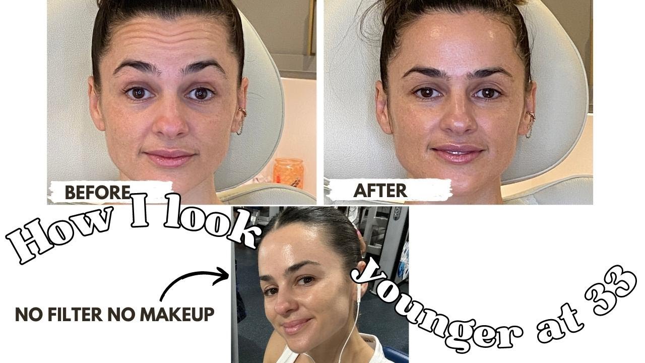 I GOT INJECTIONS!!! before and after - YouTube