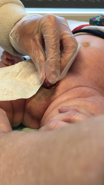 Catheter removal after hypospadias repair with Dr. Bush and Dr. Snodgrass of PARC Urology