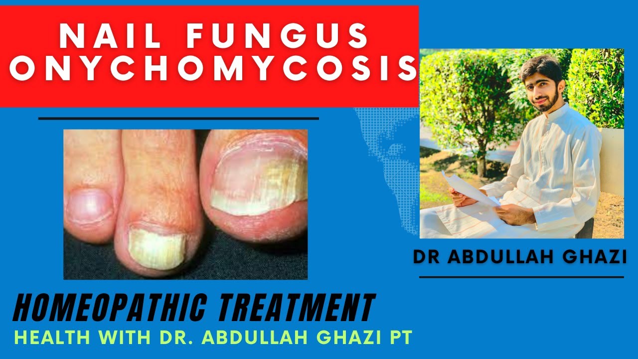 Onychomycosis / Nail Fungus. Homeopathic Treatment = Dr Abdullah Ghazi YouTube