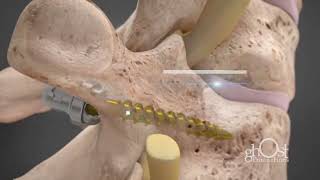 Proficient Screw System - Spine Wave