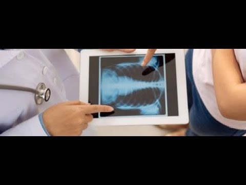 Wideo: Zespół Tietze: Objawy, Przyczyny, Diagnoza I Leczenie