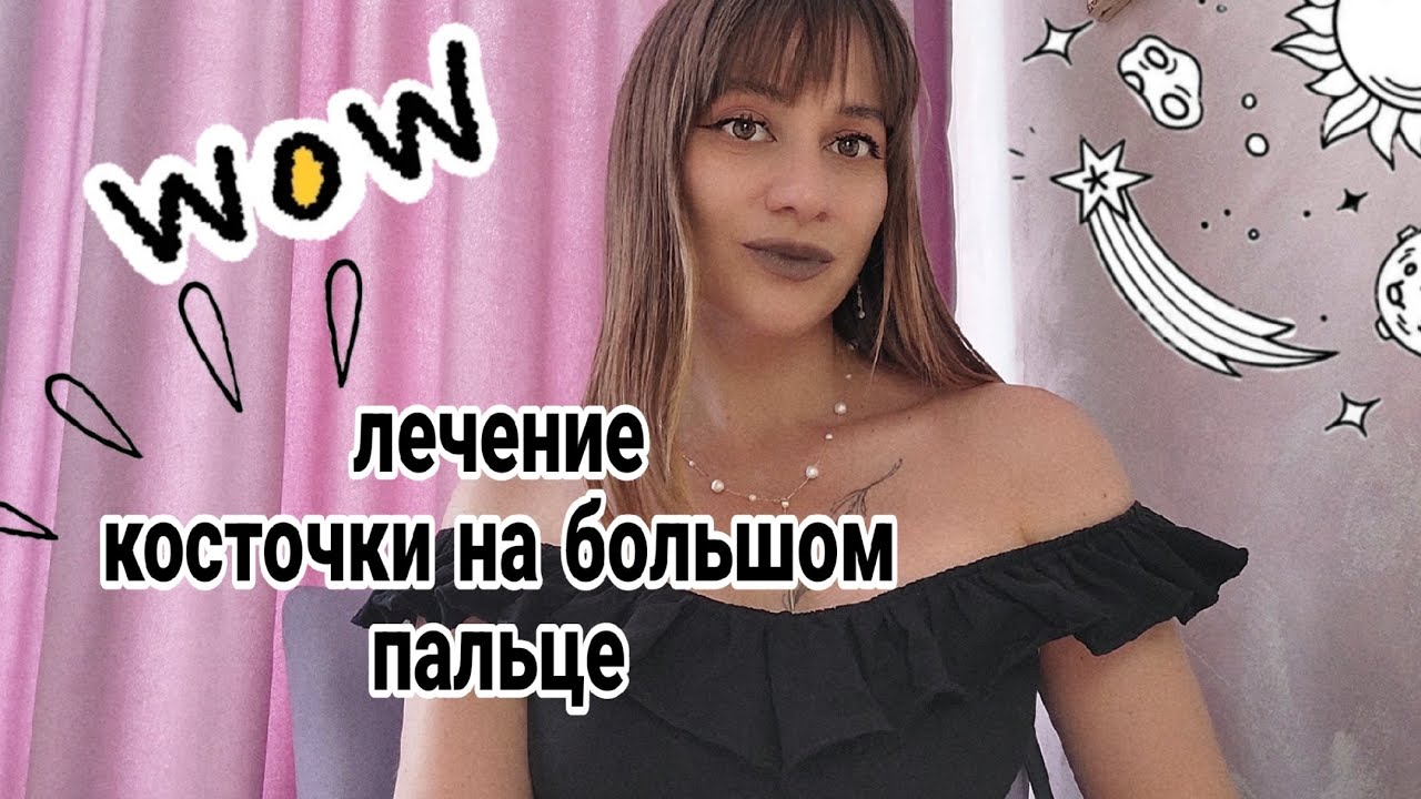 Лечение косточки на большом пальце или Вальгусная деформация ...