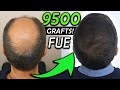 Kay´s 9500 Graft FUE Hair Transplant Transformation!!! NW 6