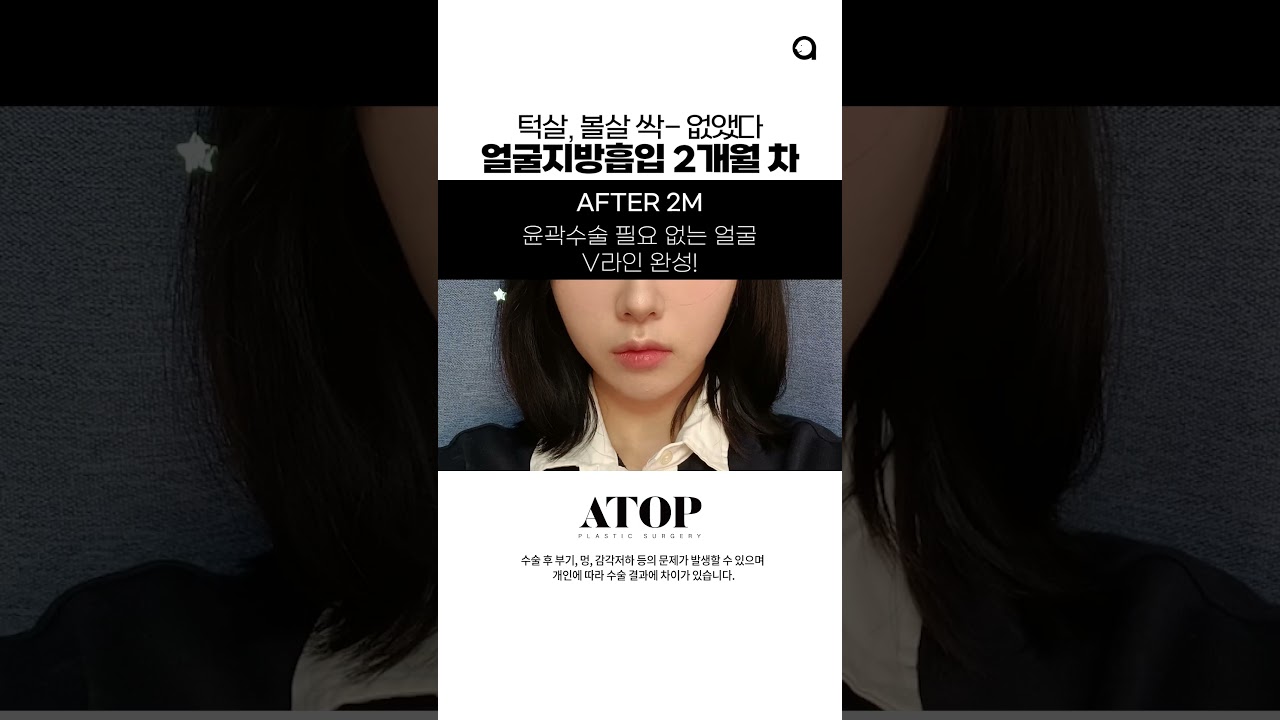 [Эйтоп гоо сайхны мэс заслын эмнэлэг] Эйтоп гоо сайхны мэс заслын эмнэлгийн нүүрний өөх соруулалт, 3 сарын дараах #Өөхсоруулах