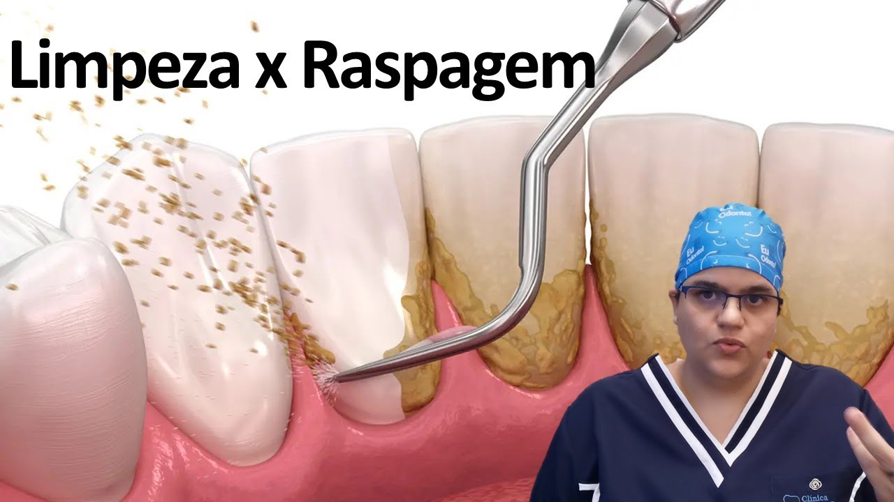 Qual a diferença entre limpeza e raspagem? | Dra Bianca Rosa | Clínica ...
