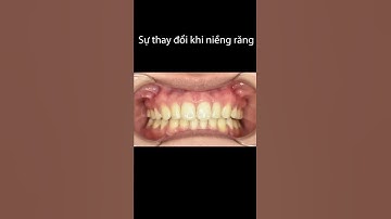 Răng cửa hình cánh bướm thay đổi như thế nào sau niềng răng?