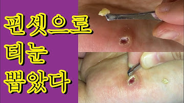 티눈 일기 #5 드디어 뽑았네요  | Corn removal