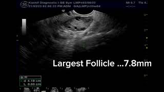 PCOS Polycystic Ovaries | Grading Mild |  Polycystic Ovarian Syndrome | PCOD | Ultrasound