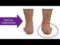 Successful orthotic treatment