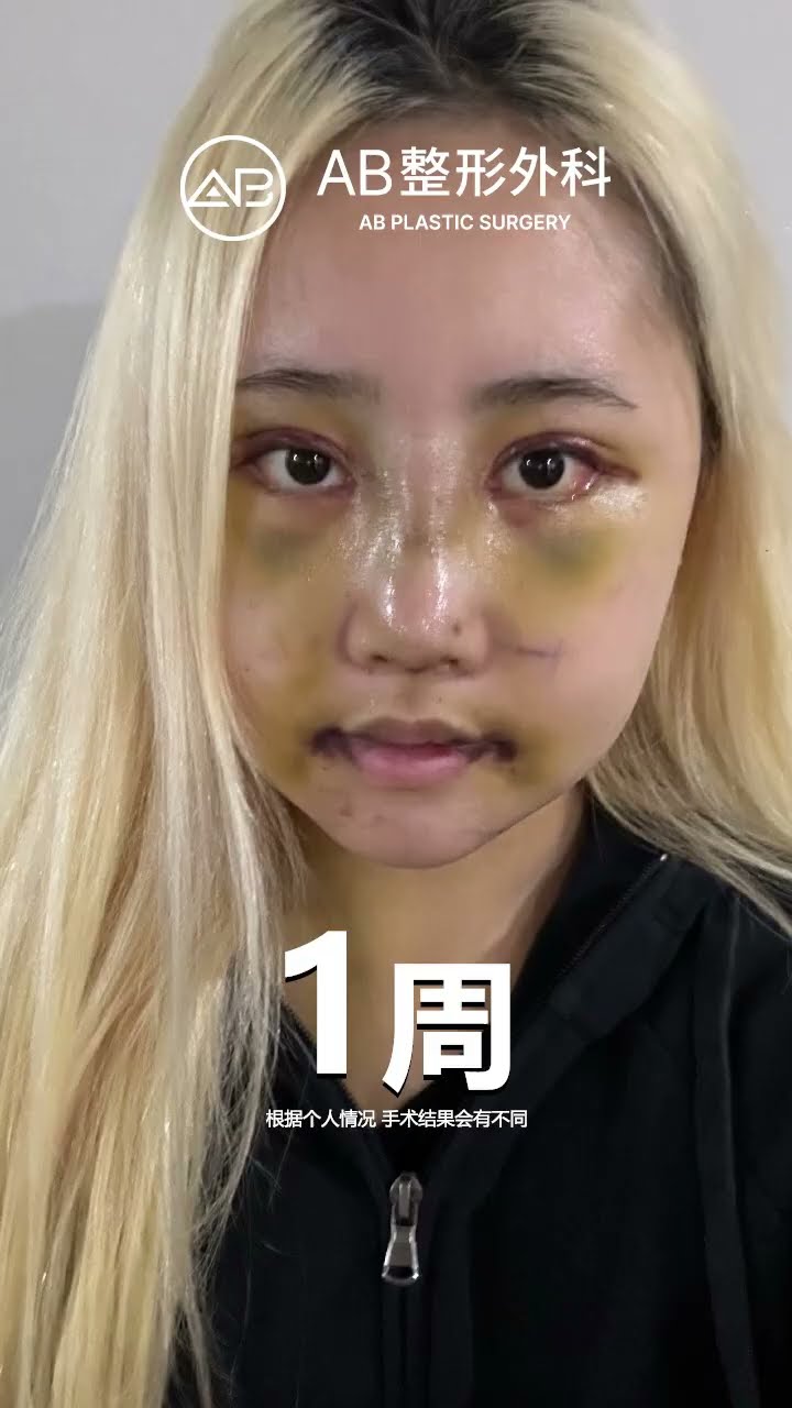 【韩国医美】AB整形醫院 before&after_案例分享 #肋骨鼻 #削骨 #雙眼皮重修 #台灣 #韓国