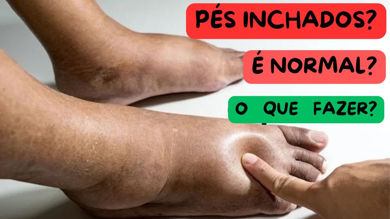 Pés INCHADOS no PÓS PARTO - PORQUE ISSO ACONTECE - COMO DESINCHAR OS ...