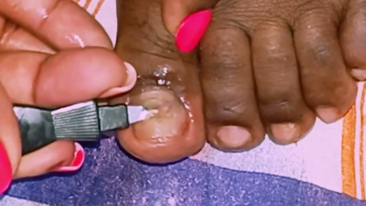 EASY TOENAIL CARE AT HOME 