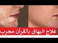 مجربا رقيه علاج مرض البهاق مهمه كانت فترة المرض بطريقه سهله جدا الراقيه ريا ام بكر
