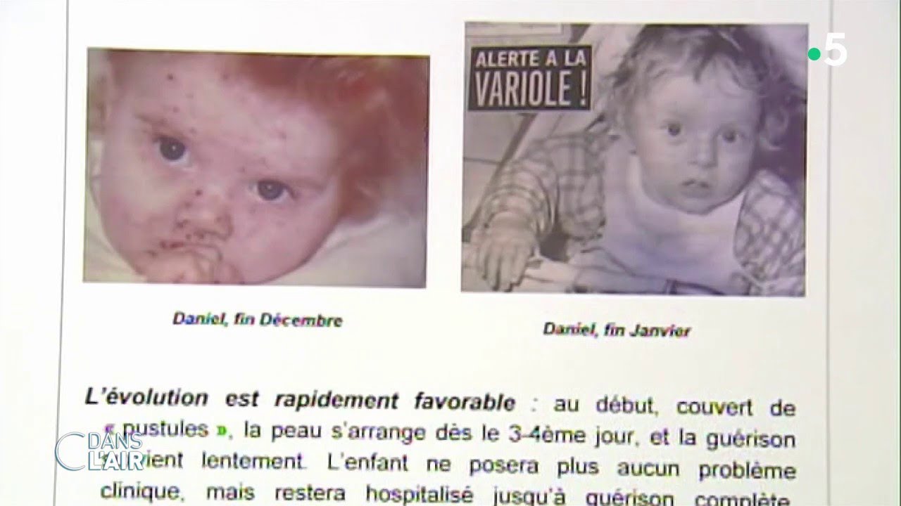 Vannes : retour sur la dernière épidémie de variole en France - Reportage #cdanslair 02.03.2020