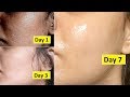 Skin Repair | Close Large OPEN PORES in 1 week, Remove Dark Spots, Anti Aging