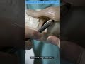 Операция по замене коленного сустава | Объяснил за 2 минуты!!!
