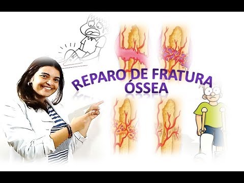 Vídeo: Reparo Da Fratura óssea: Procedimento, Preparação E Riscos