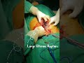 Dx# Large Uterine rupture following normal vaginal Delivery repaired successfully.