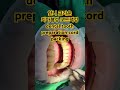 앞니 크라운 치아형성 마진을 위한 코드팩킹 dental tooth preparation cord packing