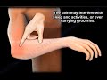 Tennis elbow, what is Tennis elbow  and why it hurts ? Tennis elbow symptoms, causes and treatment.