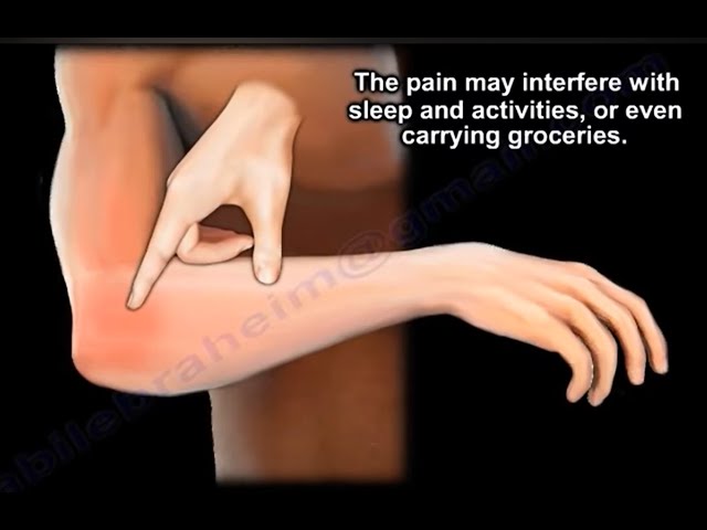 Doven Disciplin hale Tennis elbow, what is Tennis elbow and why it hurts ? Tennis elbow  symptoms, causes and treatment. - YouTube