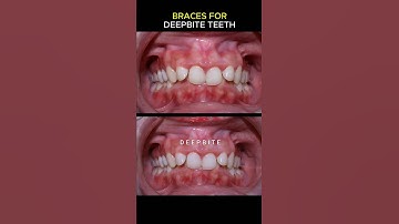 Why you should fix deep bite teeth #braces #orthodontist #dentist