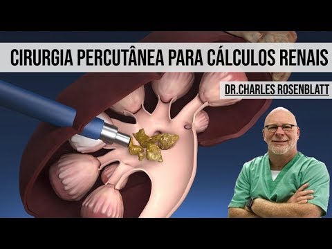 Cirurgia Percutânea para Cálculos Renais