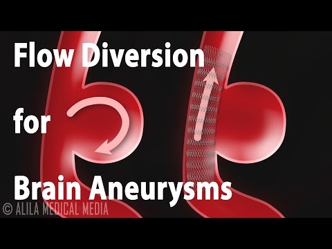 Flow Diversion for Brain Aneurysm, Animation.