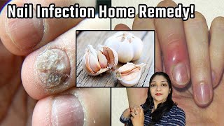 Nail fungus treatment\ nail infection treatment \ nakhun kharabho jaye to kya kare| @Anmol health