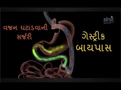 obesity-(-weight-loss-/bariatric)-surgery:-laparoscopic-gastric-bypass-surgery,-ahmedabad,-gujarat