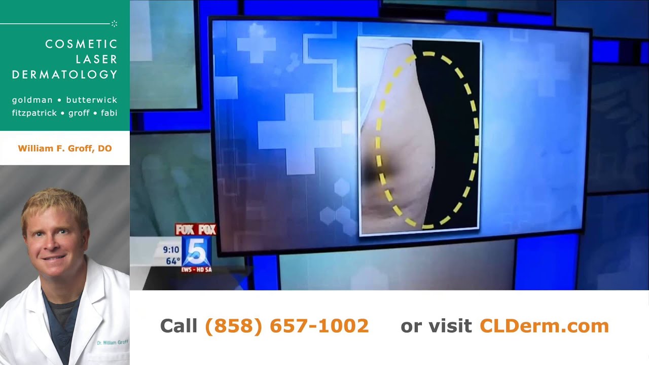 Banner for Ask the Derm: Dr. Groff Discusses CoolSculpting