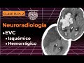 13.2 -  Neuroradiología: EVC isquémico y hemorrágico