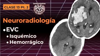 13.2 -  Neuroradiología: EVC isquémico y hemorrágico