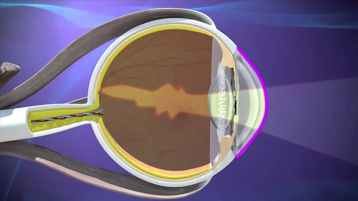 IOL Patient Education DVD - Astigmatism