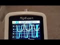 Analysis of 2nd Multi-Turn Loop Antenna and Tuner Settings