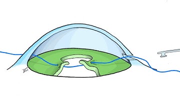 Single Pass Four Through Pupilloplasty - SFT using Seipser technique