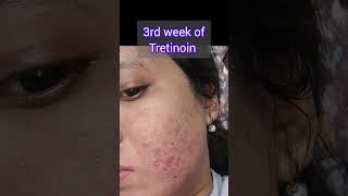 Tretinoin before and after 7 weeks// that wasn't an easy journey// Description ✌️ screenshot 2