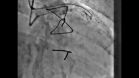Retrograde cto ostial LAD.Post CABG.