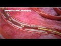 Shockwave ivl mechanism of action moa animation global