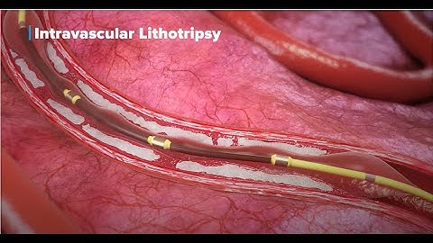 Shockwave IVL Mechanism of Action (MOA) Animation (Global)