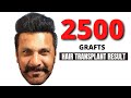 2500 grafts FUE hair transplant result in India | GRADE 4 | Darling Buds Clinic