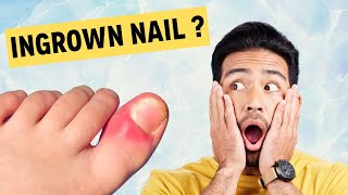 Fix Ingrown Nails - Nakhun Ke Masail - Avoid Nail Infections - Dukhte Nakhun Ka Behtarin Hal