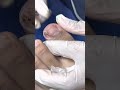 Ep_5372 *Ingrown toenail removal 👣 รู้สึกว่ามีอะไรอยู่ด้านในเล็บครับ 😊 (clip from Thailand)