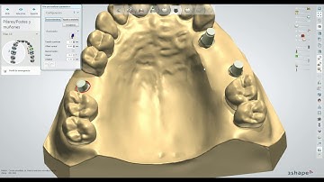 3Shape Digital Workflow for Hollow System.